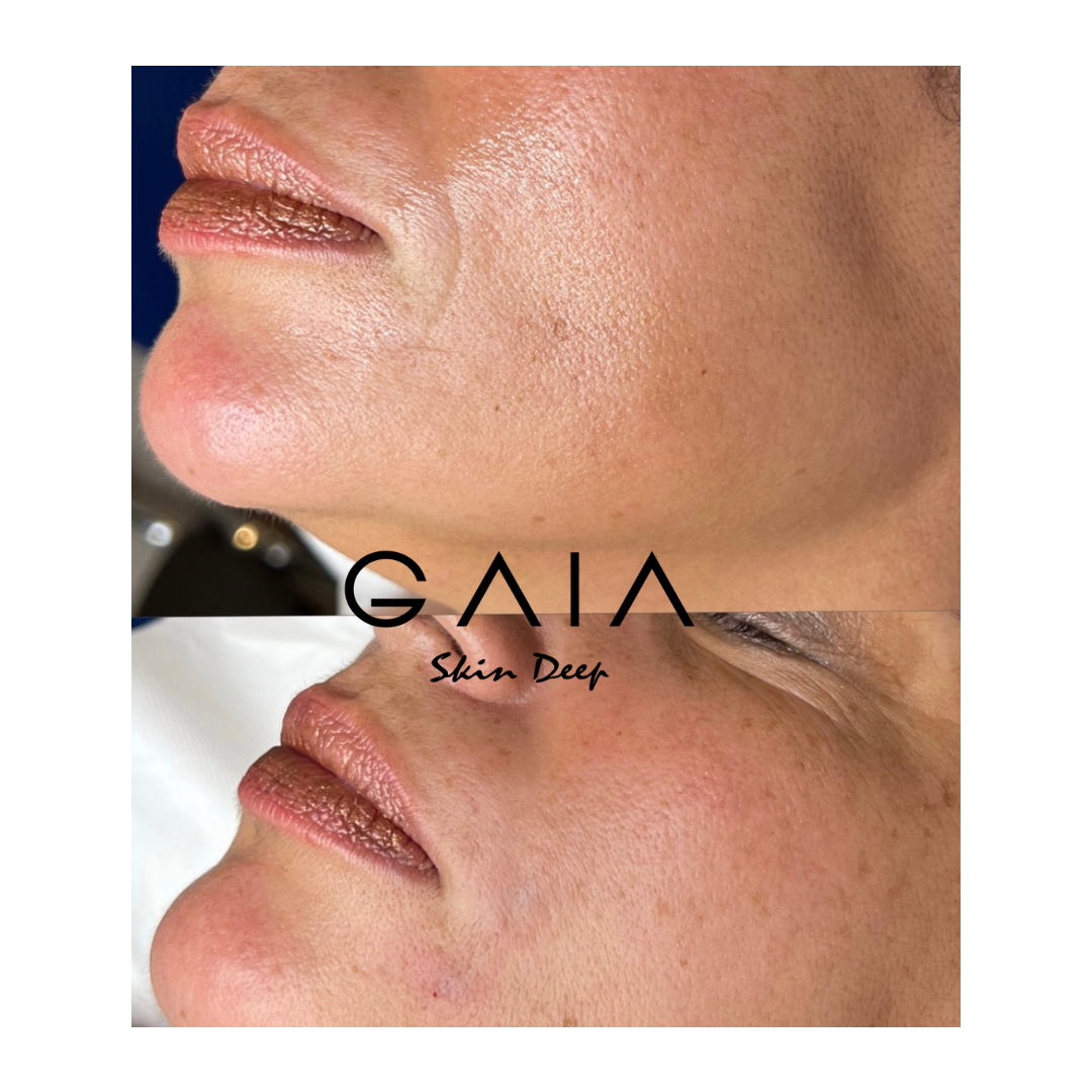 SKIN BOOSTER | SKIN HYDRATION | SEVENTY HYAL | LEMON BOTTLE