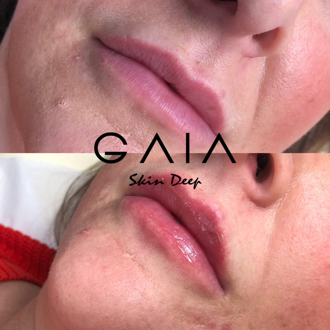 RUSSIAN LIP FILLER | RUSSIAN LIP FILLER TECHNIQUE| BRISTOL LIP FILLER| BRISTOL RUSSIAN LIPS| LIP FILLR BRISTOL NEAR ME