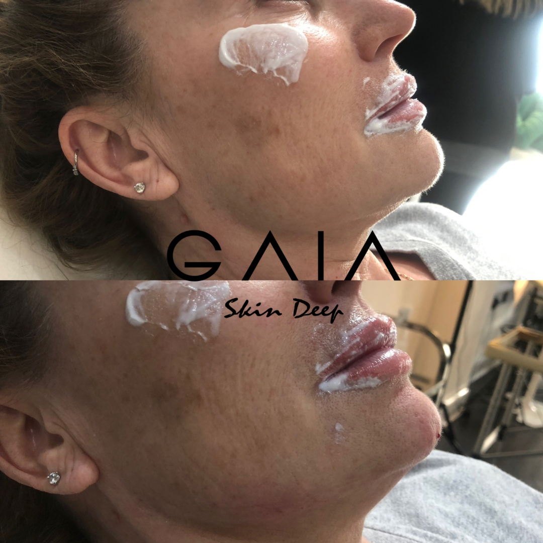 JAW AUGMENTATION | JAW FILLER | JAW FILLE BRISTOL | BRISTOL JAW FILLER | JAW AUGUMENTATION BIRSTOL NEAR ME | BRISTOL AESTHETICS NEAR ME