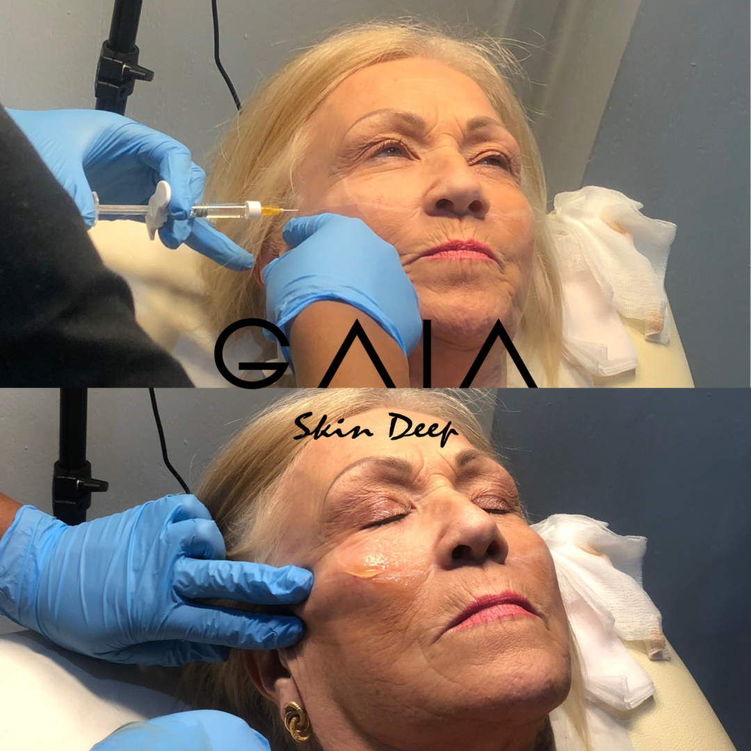 CHEEK AUGMENTATION | CHEEK FILLER| BRISTOL CHEEK FILLER| BRISTOL CHEEK FILLER NEAR ME
