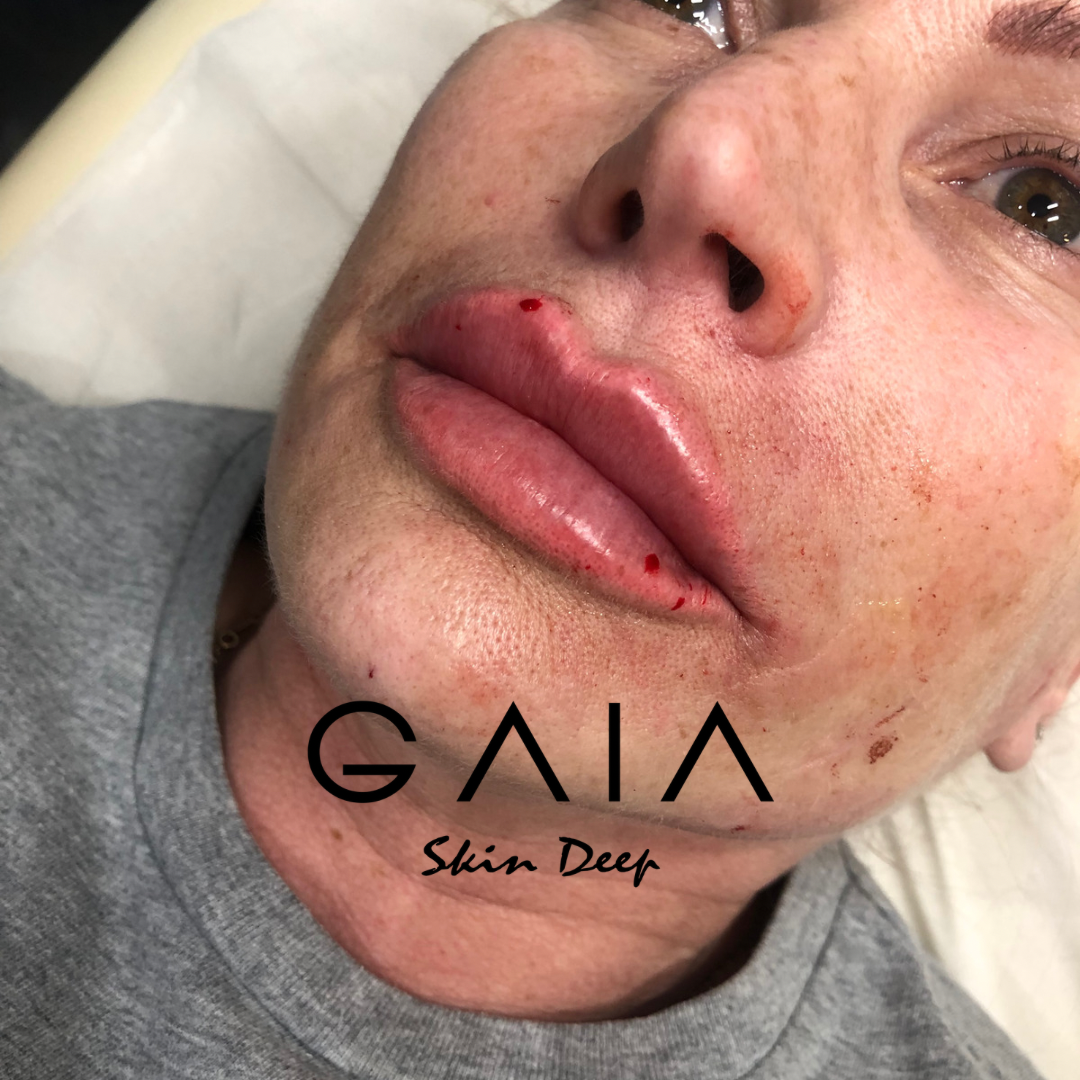 RUSSIAN LIP FILLER | RUSSIAN LIP FILLER TECHNIQUE| BRISTOL LIP FILLER| BRISTOL RUSSIAN LIPS| LIP FILLR BRISTOL NEAR ME