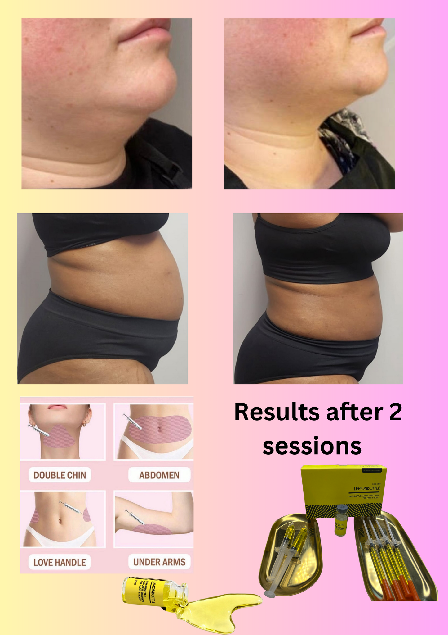 Fat Dissolving injections Bristol - GAIA SKIN DEEP