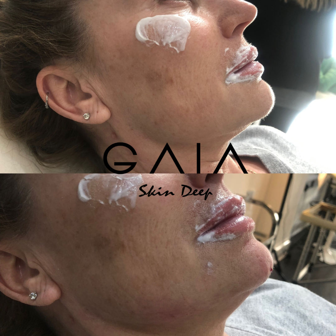 JAW AUGMENTATION | JAW FILLER | JAW FILLE BRISTOL | BRISTOL JAW FILLER | JAW AUGUMENTATION BIRSTOL NEAR ME | BRISTOL AESTHETICS NEAR ME 