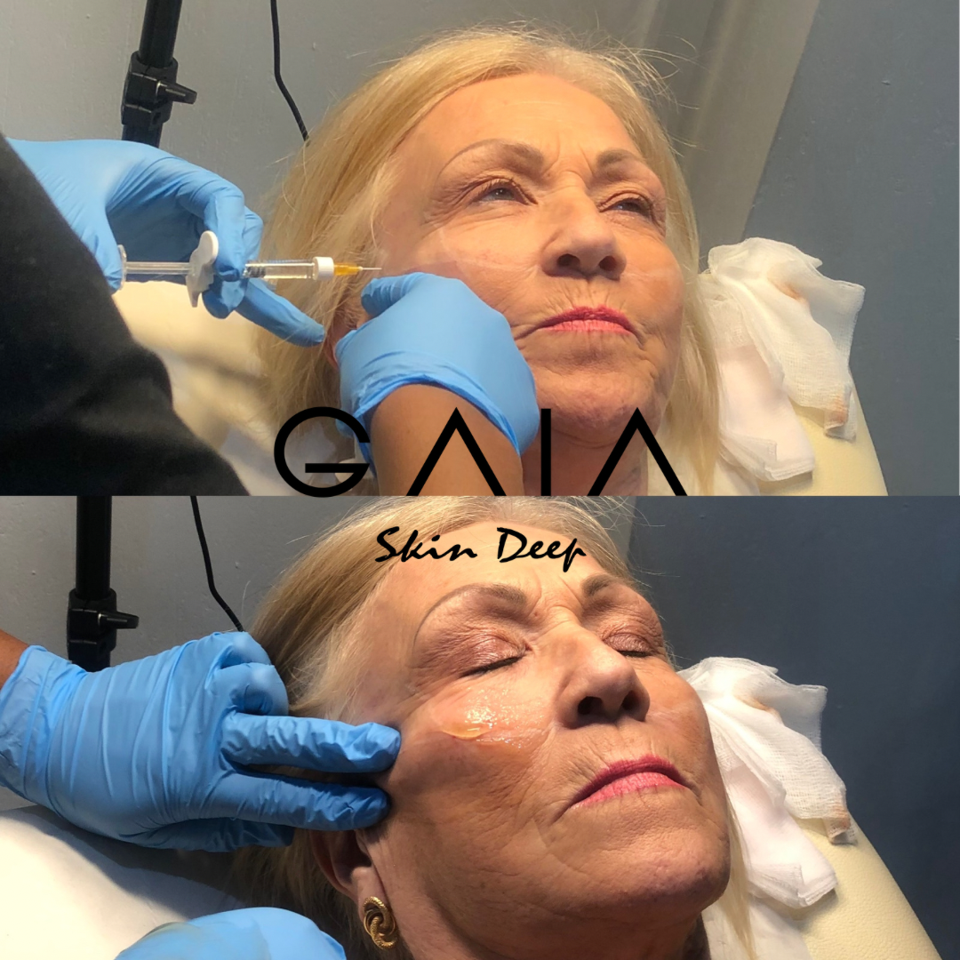 CHEEK AUGMENTATION | CHEEK FILLER| BRISTOL CHEEK FILLER| BRISTOL CHEEK FILLER NEAR ME 