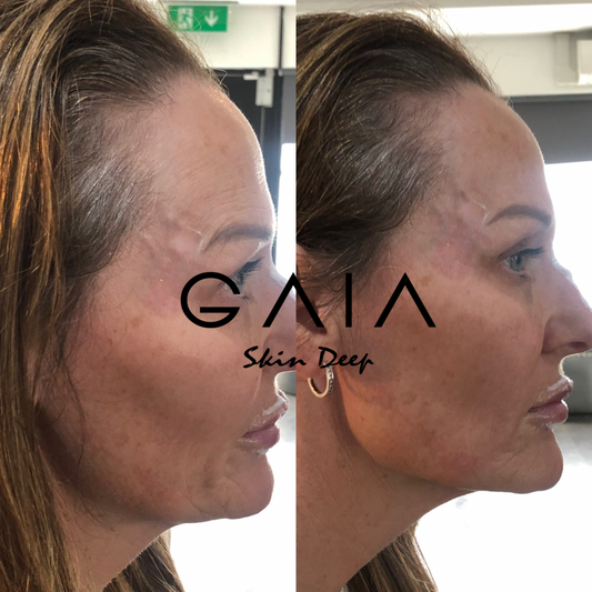 JAW AUGMENTATION | JAW FILLER | JAW FILLE BRISTOL | BRISTOL JAW FILLER | JAW AUGUMENTATION BIRSTOL NEAR ME | BRISTOL AESTHETICS NEAR ME 