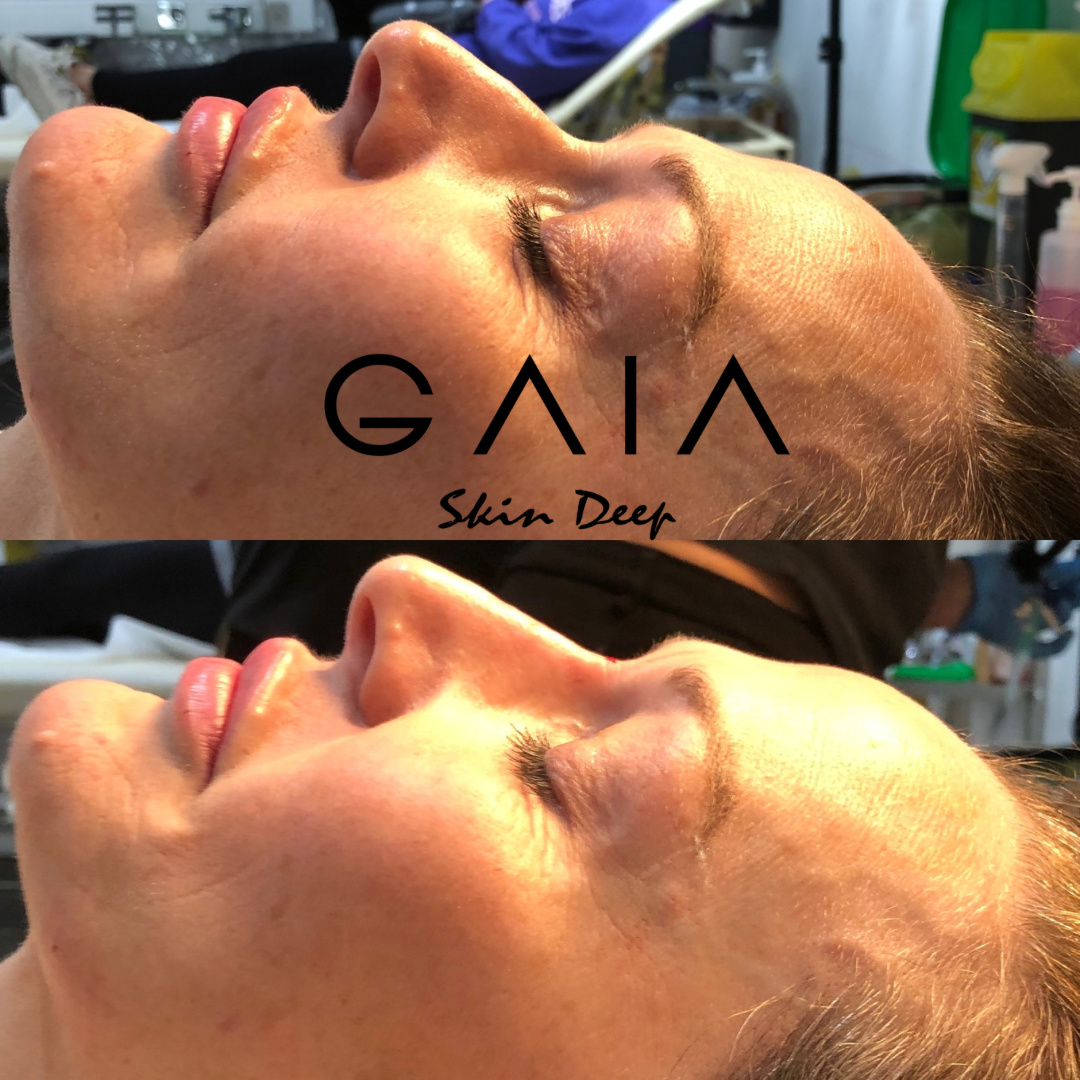 Non surgical rhinoplasty | Liquid rhinoplasty| Bristol Non surgical nose| Bristol Nose Filler| Pixy nose Bristol