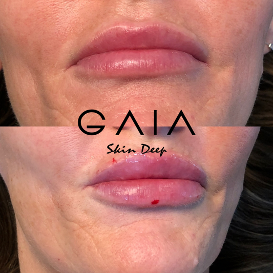 RUSSIAN LIP FILLER | RUSSIAN LIP FILLER TECHNIQUE| BRISTOL LIP FILLER| BRISTOL RUSSIAN LIPS| LIP FILLR BRISTOL NEAR ME