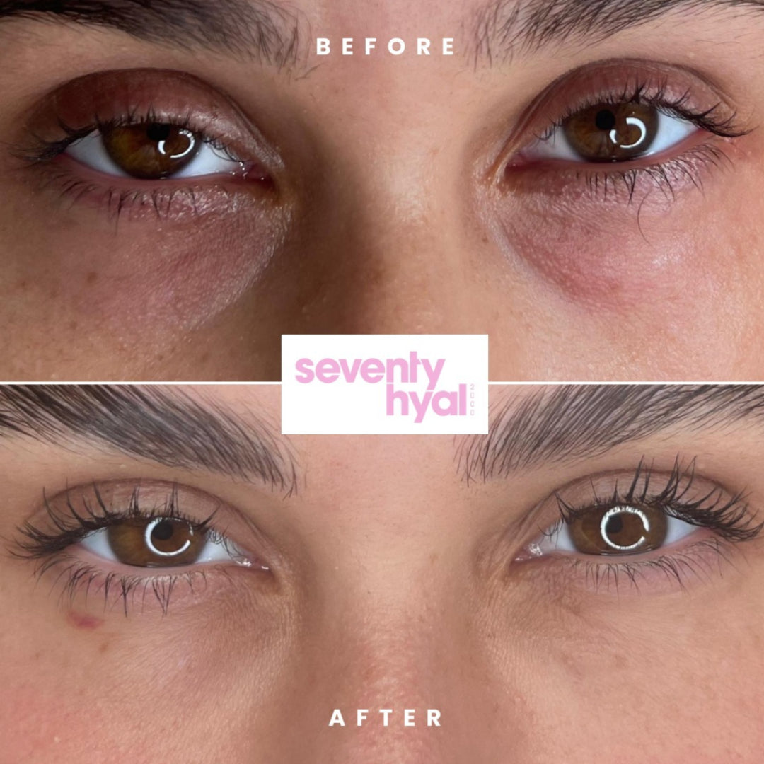SEVENTY HYAL| SKIN BOOSTER TREATMENT BRISTOL| TEAR TROUGH BRISTOL| TEAR TROUGH NEAR ME 