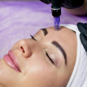 MICRONEEDLING FACIAL BRISTOL - GAIA SKIN DEEP